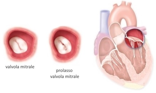 Le maggiori cause dell'insufficienza mitralica in pazienti giovani e anziani