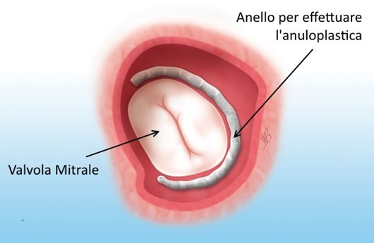 Cardioband, la nuova frontiera della chirurgia mininvasiva per trattare l’insufficienza mitralica
