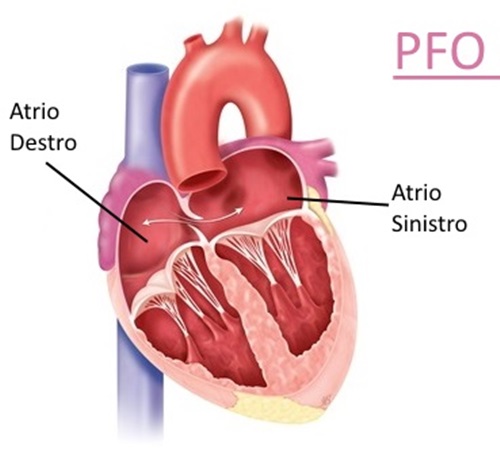 pfo-forame-ovale-previo-(1)-(2).jpg