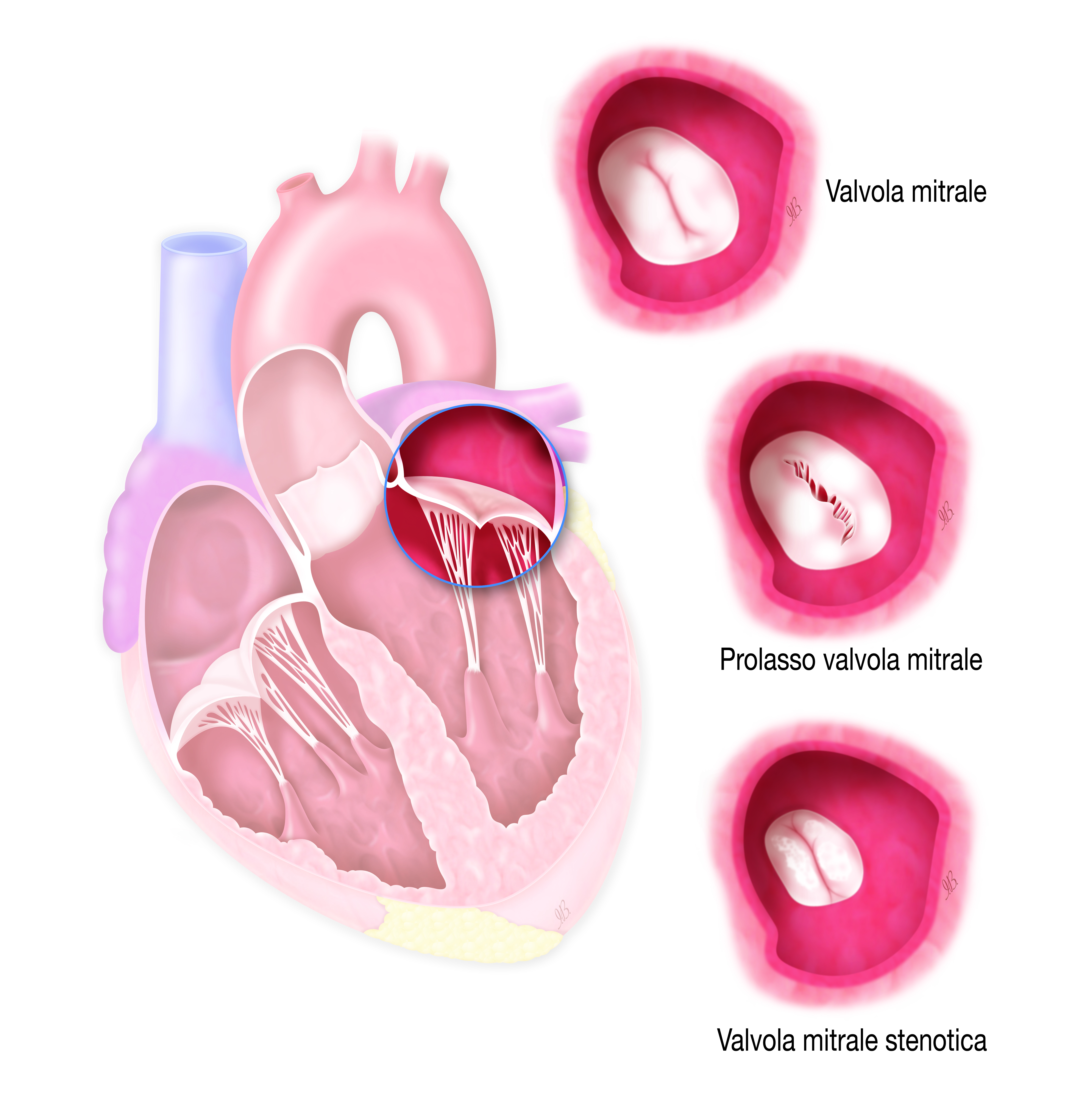 8_VALVOLA-MITRALE-SANA-E-STENOTICA.jpg