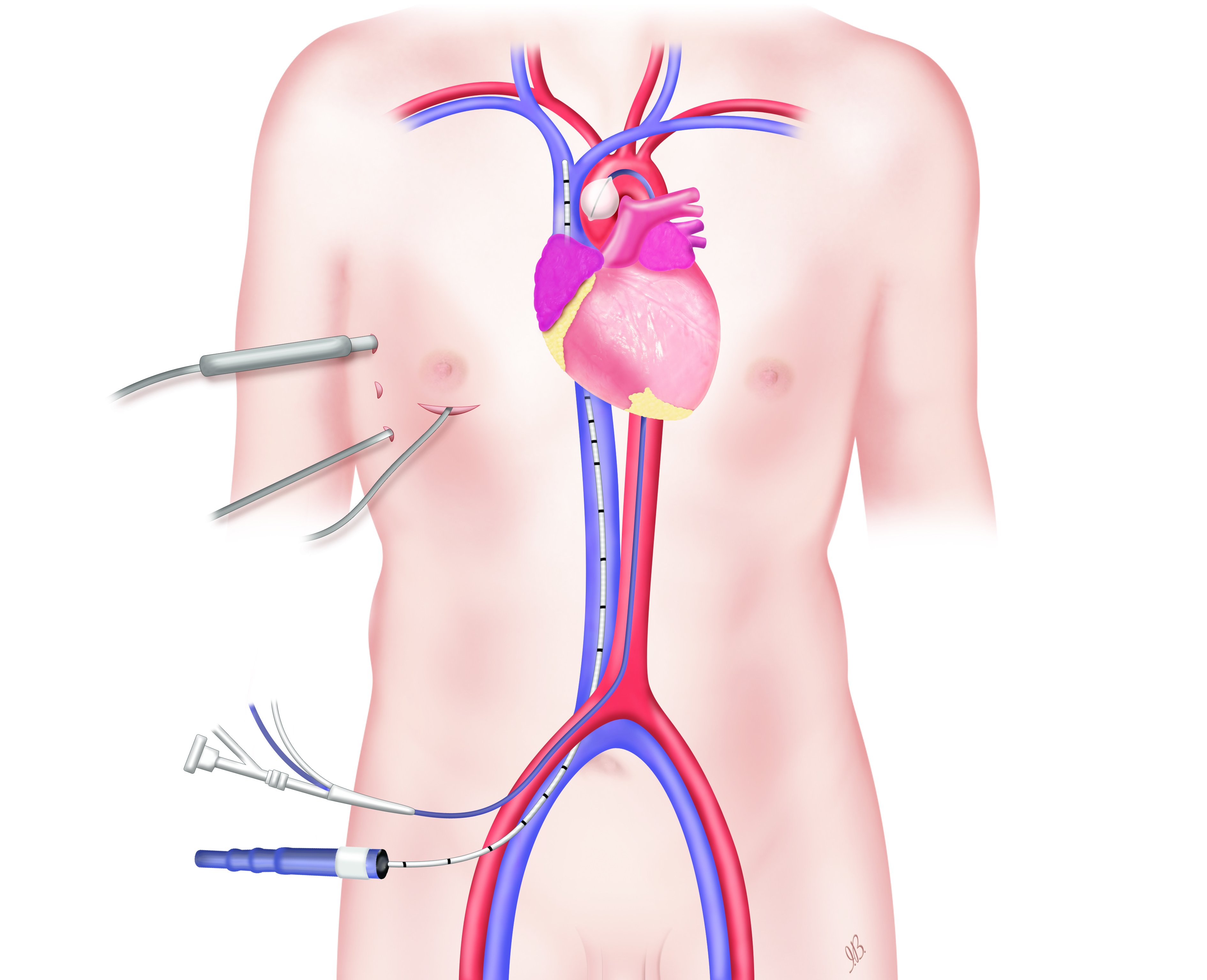 Endoclamp-(1).jpg